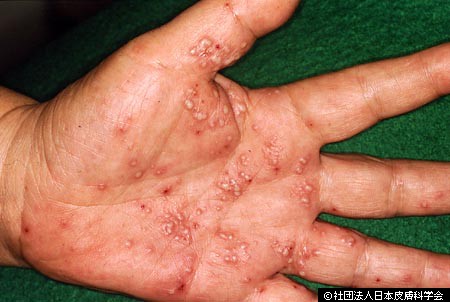 掌蹠膿疱症(しょうせきのうほうしょう)の原因と症状・治療｜吹田市